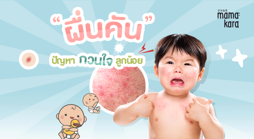 ผื่นในเด็ก