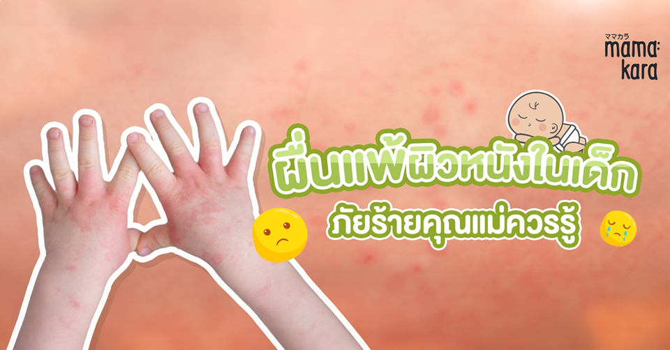 ภาพมือเด็กที่มีผื่นแดง พร้อมข้อความ “ผื่นแพ้ผิวหนังในเด็ก ภัยร้ายคุณแม่ควรรู้” ใช้เป็นภาพประกอบบทความสุขภาพเด็กจาก Mama Kara