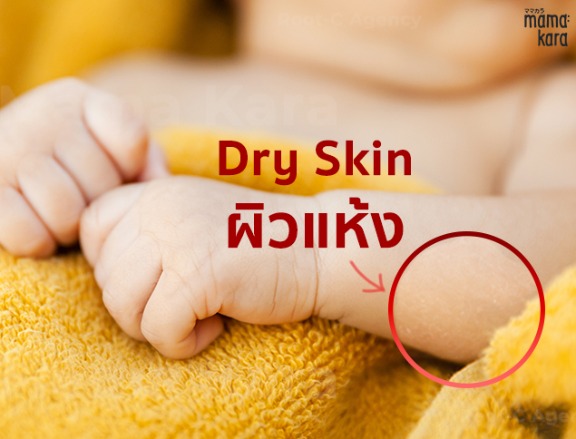 Baby Dry Skin