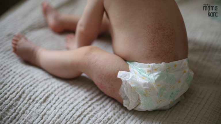 Mama Kara - Diaper Rash ผื่นผ้าอ้อม จุดแดง ในเด็ก